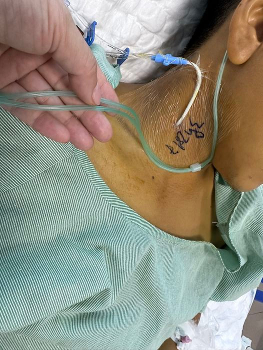 Ăn xôi tím bị ngộ độc tan máu và suy đa tạng ảnh 1 Ăn xôi tím bị ngộ độc tan máu và suy đa tạng ảnh 1