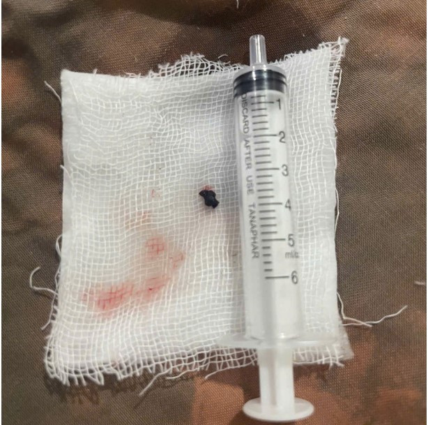 Huyết khối trong mạch não bệnh nhân được lấy ra sau can thiệp - Ảnh bSCC