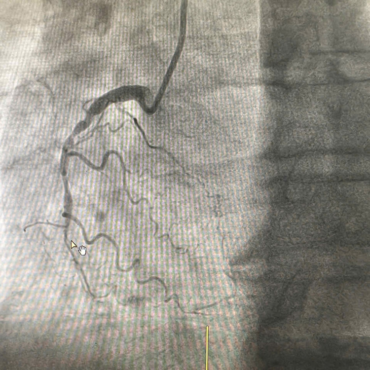 Cứu bệnh nhân nhồi máu cơ tim cấp có tiền sử hút thuốc lá nhiều năm ảnh 3