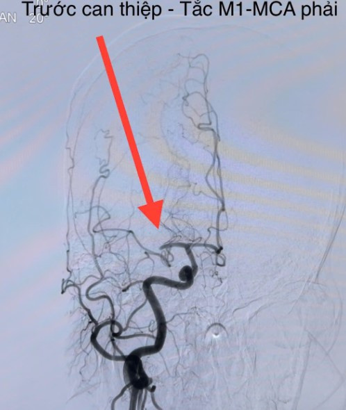 Hình ảnh đột quỵ não do tắc nghẽn mạch máu não - Ảnh BSCC