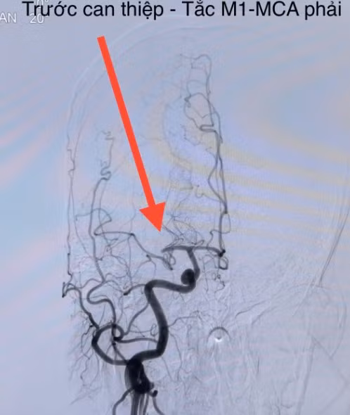 Hình ảnh đột quỵ não do tắc nghẽn mạch máu não - Ảnh BSCC Hình ảnh đột quỵ não do tắc nghẽn mạch máu não - Ảnh BSCC