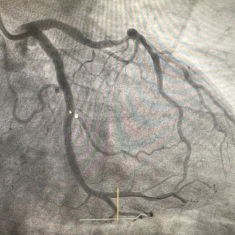 Cứu bệnh nhân nhồi máu cơ tim cấp có tiền sử hút thuốc lá nhiều năm ảnh 2