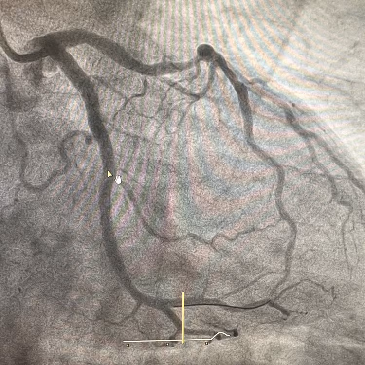 Cứu bệnh nhân nhồi máu cơ tim cấp có tiền sử hút thuốc lá nhiều năm ảnh 2