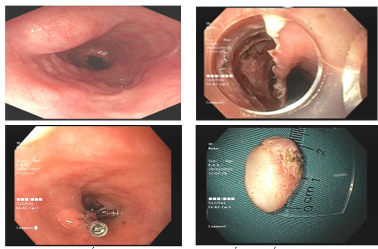 Quá trình cắt tách dưới niêm mạc ESD cắt bỏ khối u cơ thực quản - Ảnh BVCC