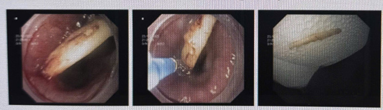 Dị vật khuyên tai nằm trong dạ dày bệnh nhân - Ảnh BVCC