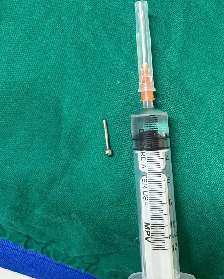 Dị vật được lấy ra - Ảnh BVCC