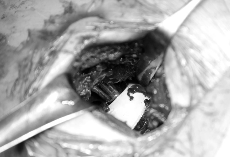 Công nghệ thay khớp háng nhân tạo tiên tiến không cắt gân cơ ảnh 3