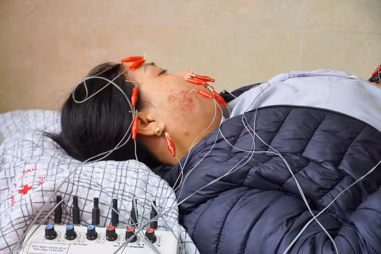 Nhiều người liệt mặt biến chứng do tự ý điều trị tại nhà - Ảnh BVCC