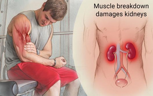 Cẩn thận biến chứng tiêu cơ vân sau chấn thương có thể gây suy thận cấp - Ảnh minh họa