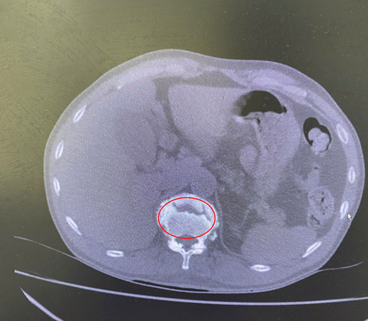 Tổn thương cột sống thắt lưng của người bệnh T. trên phim chụp CT.Scanner (vùng khoanh tròn màu đỏ)