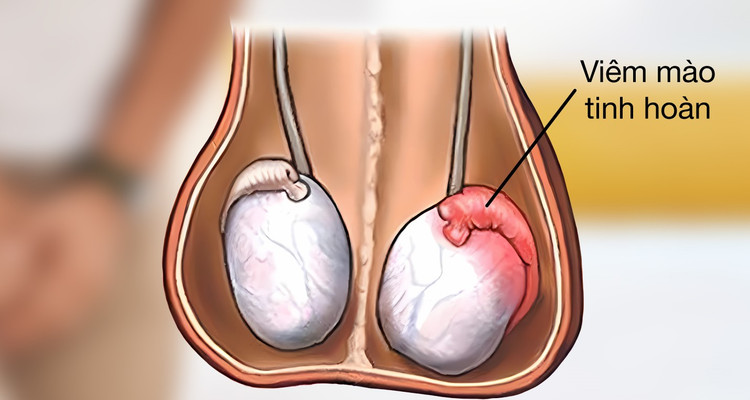 Viêm mào tinh hoàn - Ảnh minh họa
