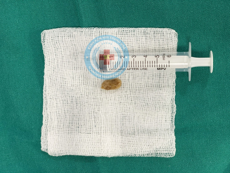 Hạt lạc trong phế quản bệnh nhi được lấy ra