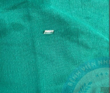 Mảnh kính đâm vào cổ bé trai được lấy ra - Ảnh BVCC