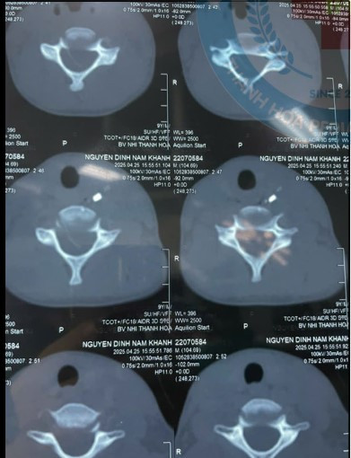 Chơi cạnh cửa lớp bé trai 9 tuổi bị mảnh kính đâm sâu vào cổ ảnh 2