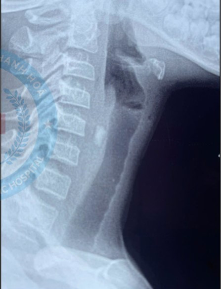 Chơi cạnh cửa lớp bé trai 9 tuổi bị mảnh kính đâm sâu vào cổ ảnh 1