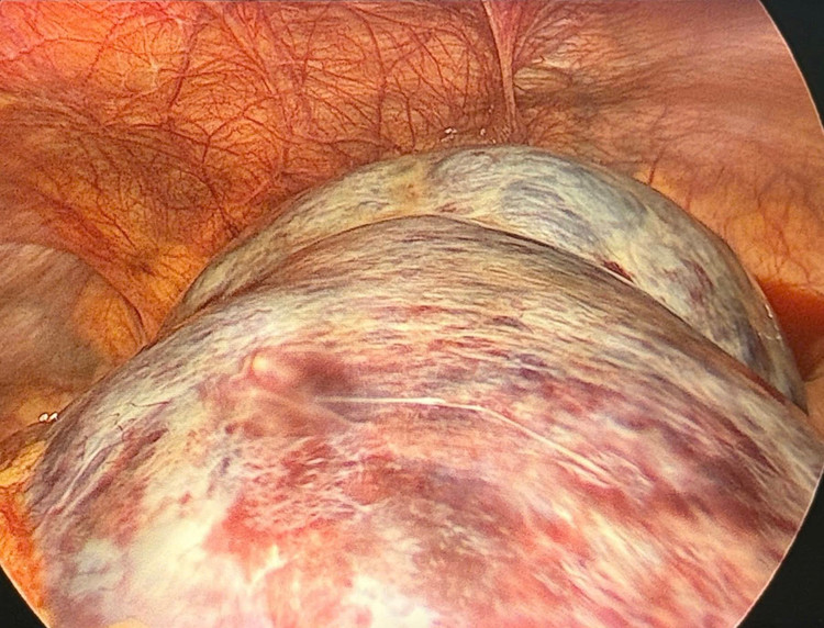 Khối u khủng trong bụng bệnh nhân - Ảnh BVCC