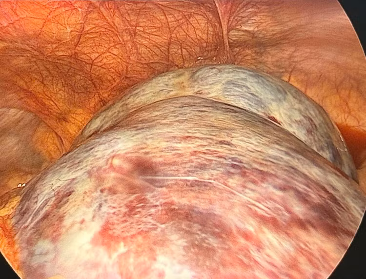 Khối u khủng trong bụng bệnh nhân - Ảnh BVCC