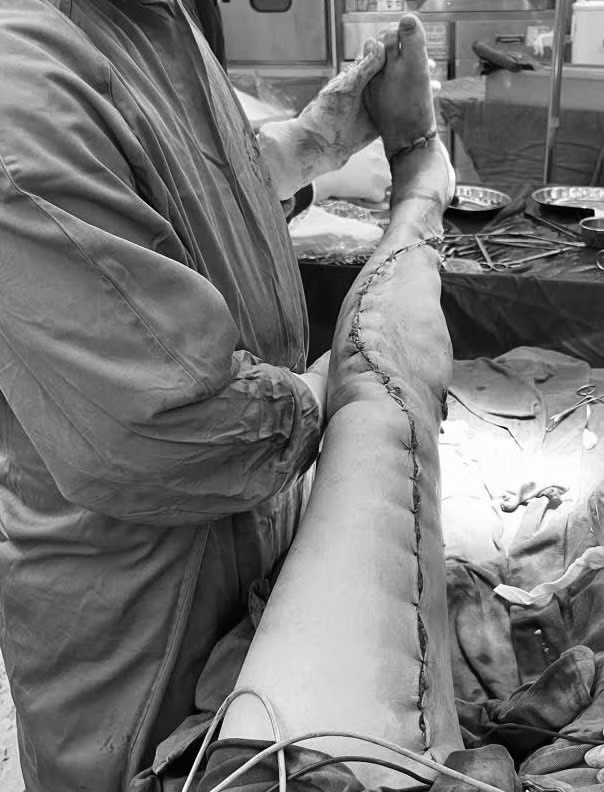 Chân bệnh nhân sau phẫu thuật - Ảnh BVCC