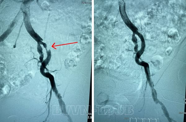 Tắc động mạch chi trước và sau can thiệp - Ảnh BVCC