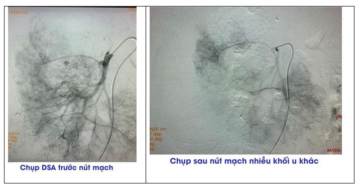 Phim chụp trước và sau nút mạch cho bệnh nhân