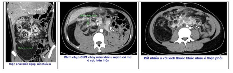 Hình ảnh phim chụp cho thấy rất nhiều khối u với kích thước khác nhau ở quả thận phải