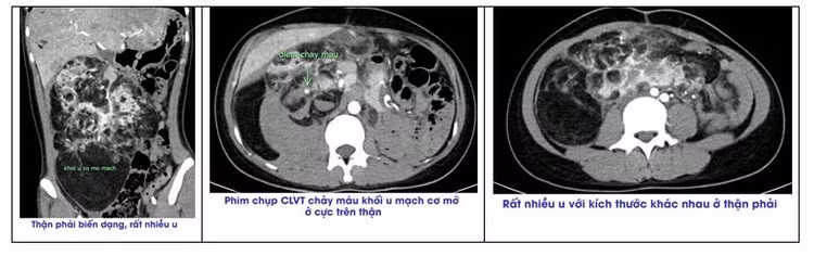 Hình ảnh phim chụp cho thấy rất nhiều khối u với kích thước khác nhau ở quả thận phải