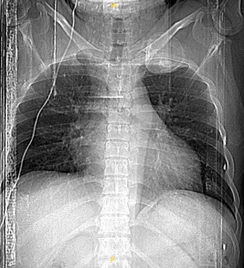 Hình ảnh u cung sau xương sườn số 1 - Ảnh BVCC