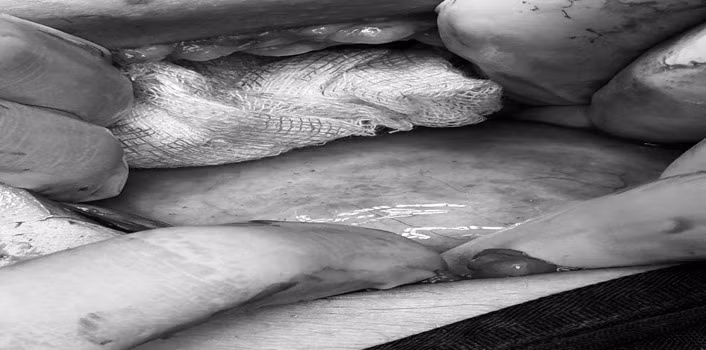 Hình ảnh u buồng trứng xoắn vặn - Ảnh BVCC