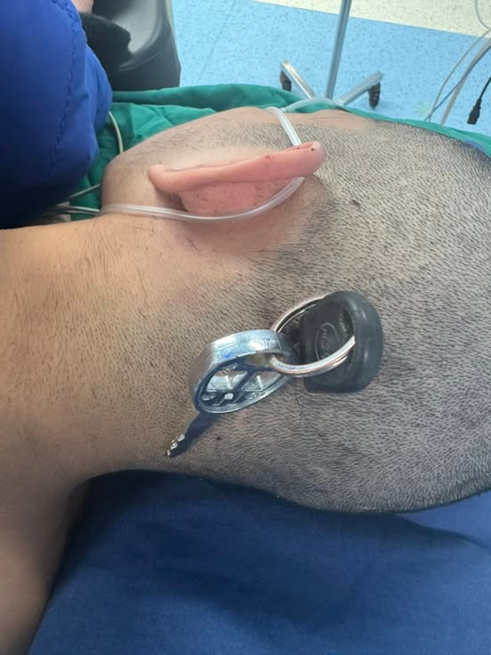 Chìa khóa cắm sâu vào đầu nam học sinh - Ảnh BVCC