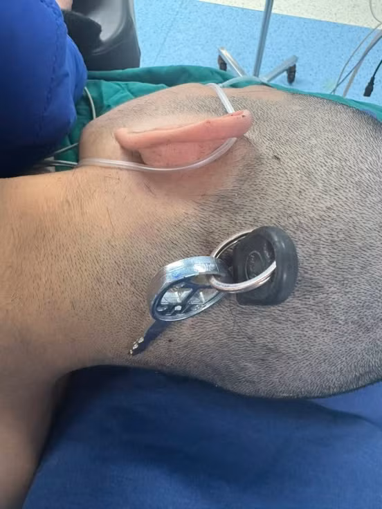 Chìa khóa cắm sâu vào đầu nam học sinh - Ảnh BVCC