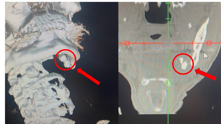 Sỏi tuyến nước bọt của người bệnh trên phim chụp - Ảnh minh họa