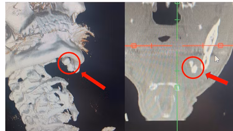 Sỏi tuyến nước bọt của người bệnh trên phim chụp - Ảnh minh họa