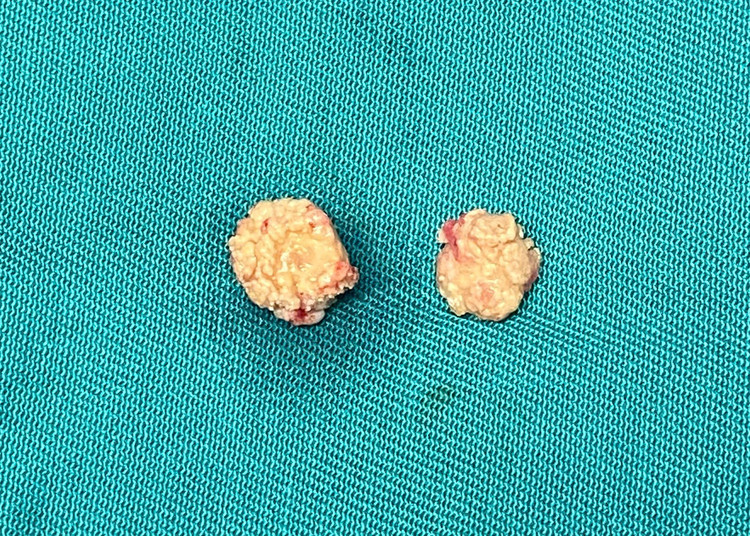 Hình ảnh viên sỏi được lấy ra sau khi phẫu thuật - Ảnh BVCC