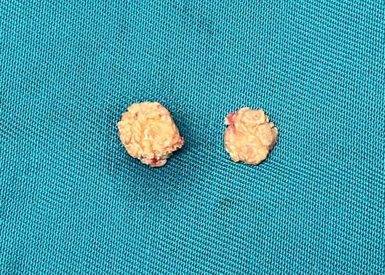 Hình ảnh viên sỏi được lấy ra sau khi phẫu thuật - Ảnh BVCC