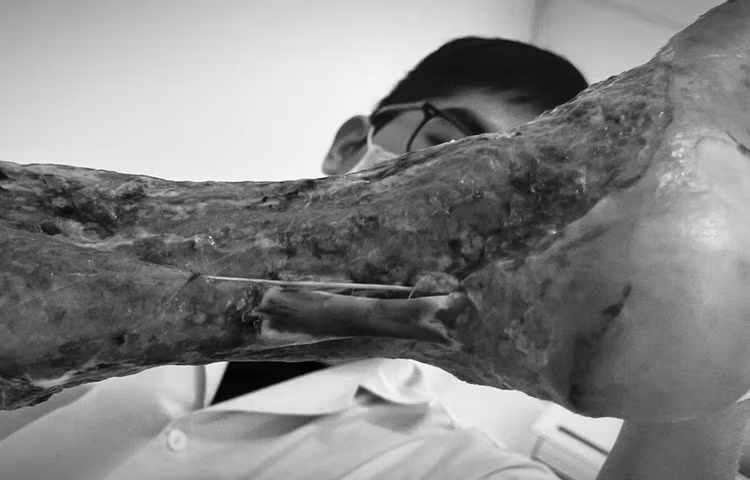 Cắt lọc hoại tử chân - Ảnh BVCC