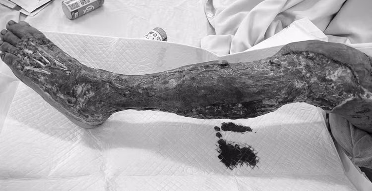 Viêm mô tế bào do nhiễm trùng Vibrio vulnificus - Ảnh BVCC