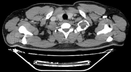 Hình ảnh u cung sau xương sườn số 1.