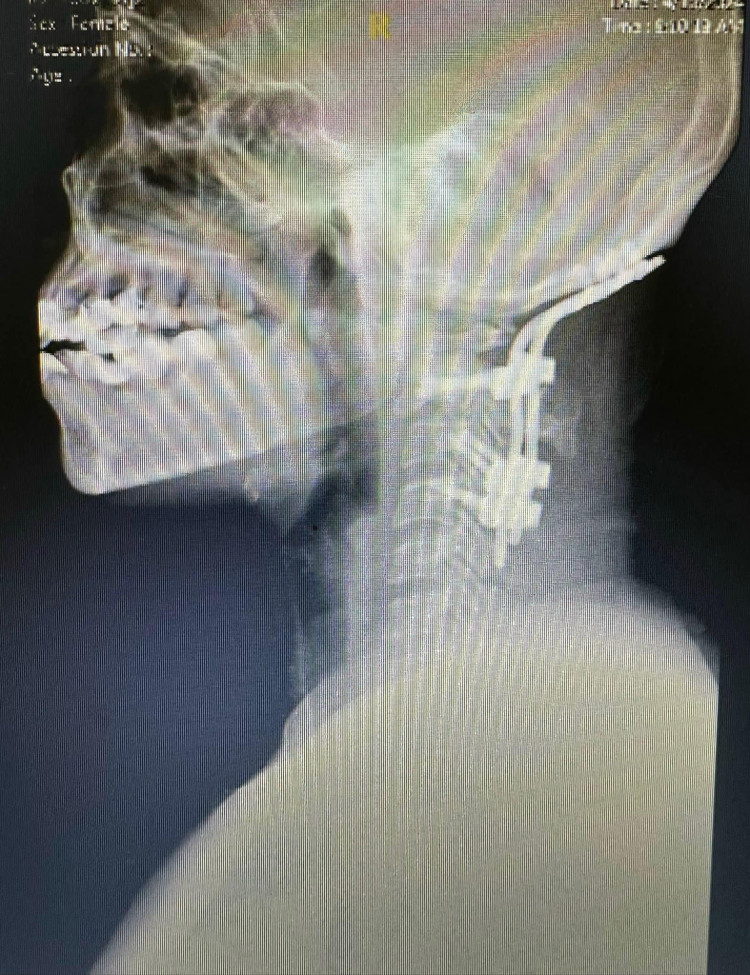 Phẫu thuật nắn chỉnh và cố định cột sống cổ và xương sọ