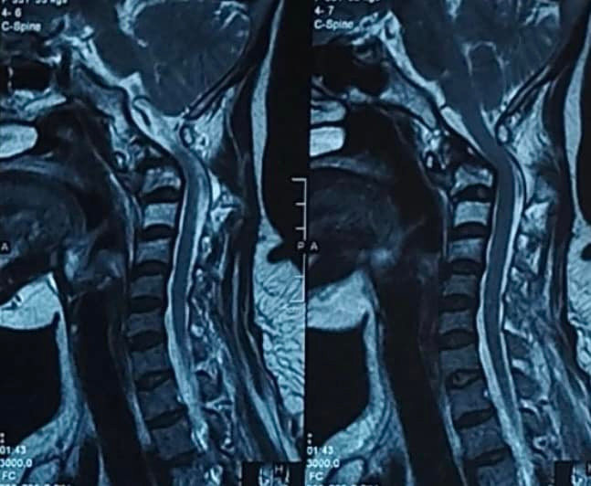 Bệnh nhân ung thư phổi di căn đốt sống cổ cao