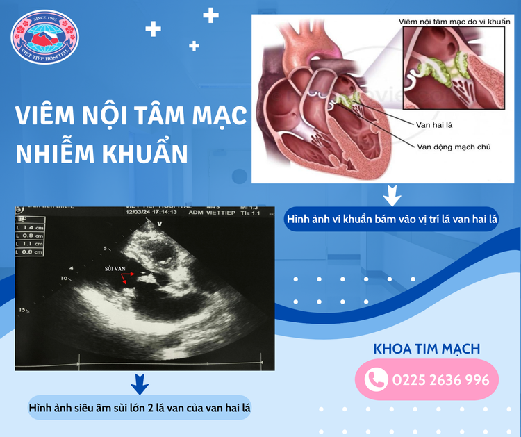 Mệt mỏi kéo dài, bệnh nhân nam 47 tuổi không ngờ viêm nội tâm mạc - Ảnh BVCC