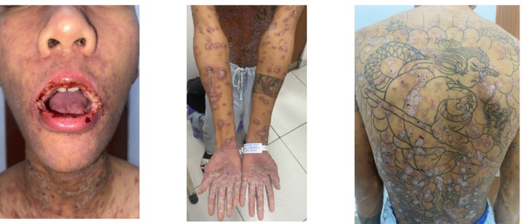 Bệnh nhân nam, 19 tuổi, vào viện với biểu hiện loét trợt niêm mạc nặng và tổn thương da đa dạng với các sẩn, mảng đỏ tím, mụn nước, bọng nước rải rác toàn thân