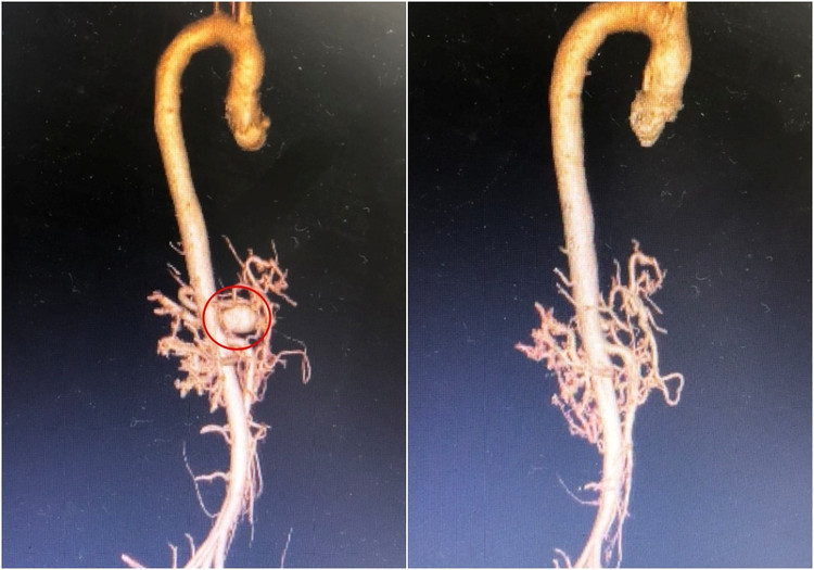 Hình ảnh chụp cắt lớp vi tính dựng hình khối phình động mạch thân tạng trước và sau phẫu thuật