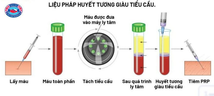 Huyết tương giàu tiểu cầu trị viêm khớp, viêm gân ảnh 1