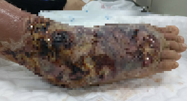 Chân hoại tử vì cho ong đốt chữa viêm khớp - Ảnh BVCC