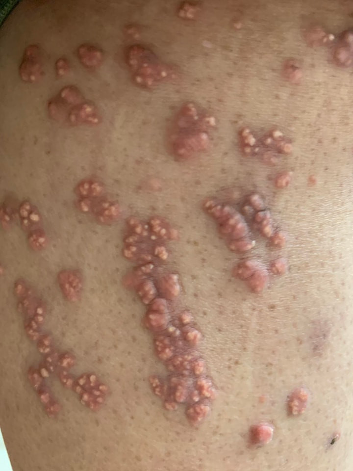 U vàng nổi khắp chân bệnh nhân