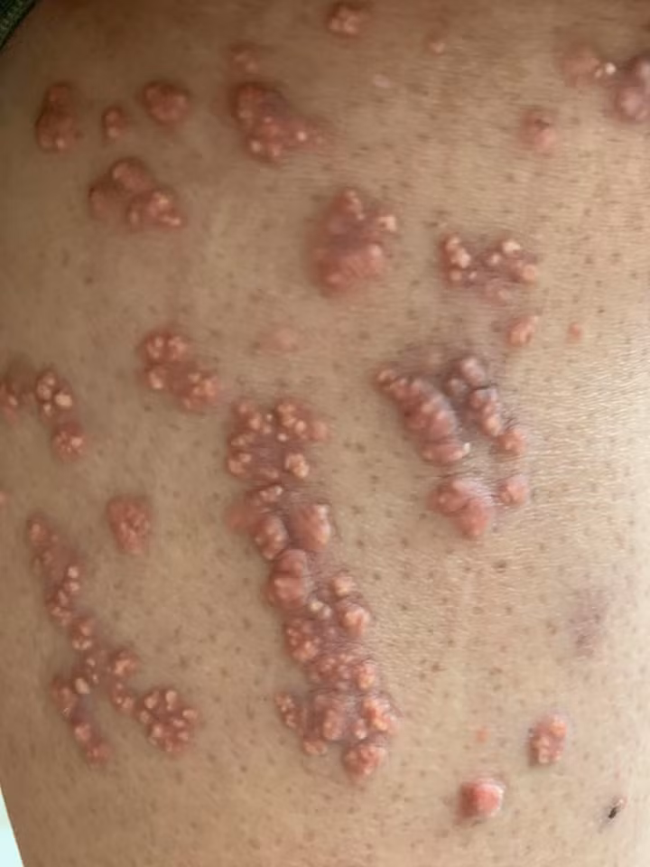 U vàng nổi khắp chân bệnh nhân