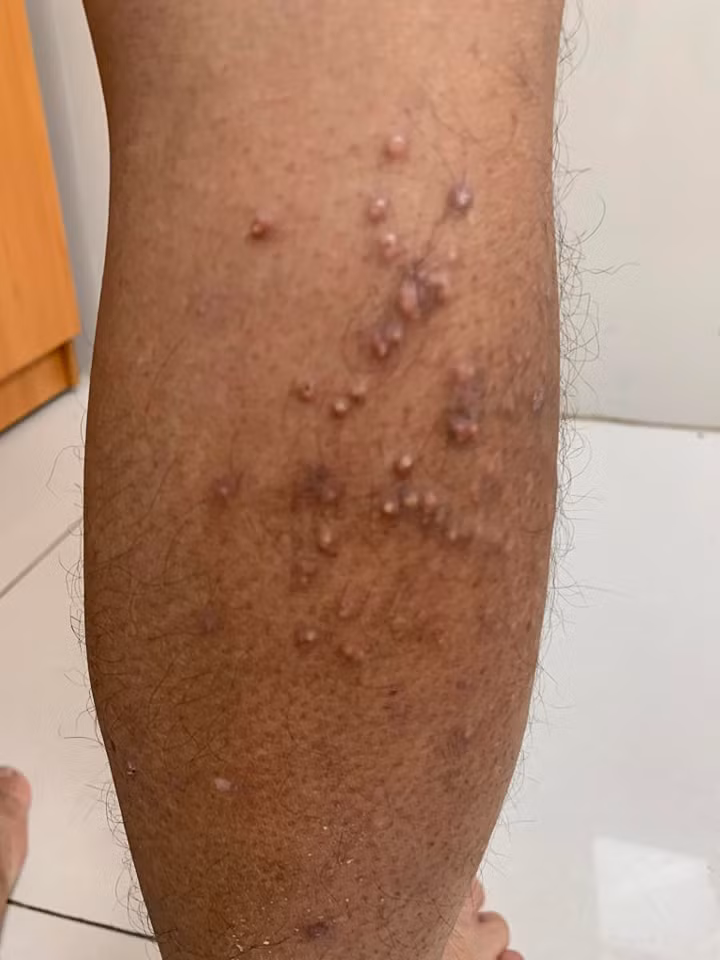 Biểu hiện của u vàng do rối loạn mỡ máu