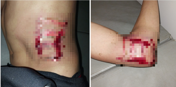 Vết thương bệnh nhân do bị sét đánh lúc mới nhập viện - Ảnh: Trung tâm Y tế huyện Bắc Sơn