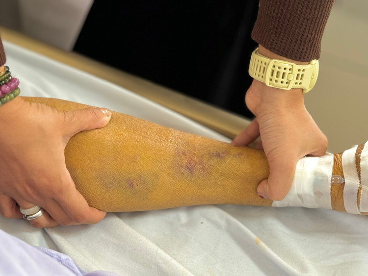 Da vàng như nghệ do tự ngừng thuốc điều trị viêm gan B - Ảnh BVCC