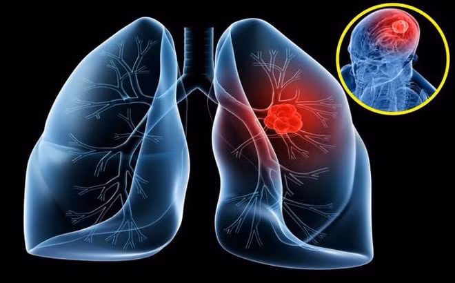 Phát hiện sớm giúp kéo dài thời gian sống cho bệnh nhân - Ảnh minh họa